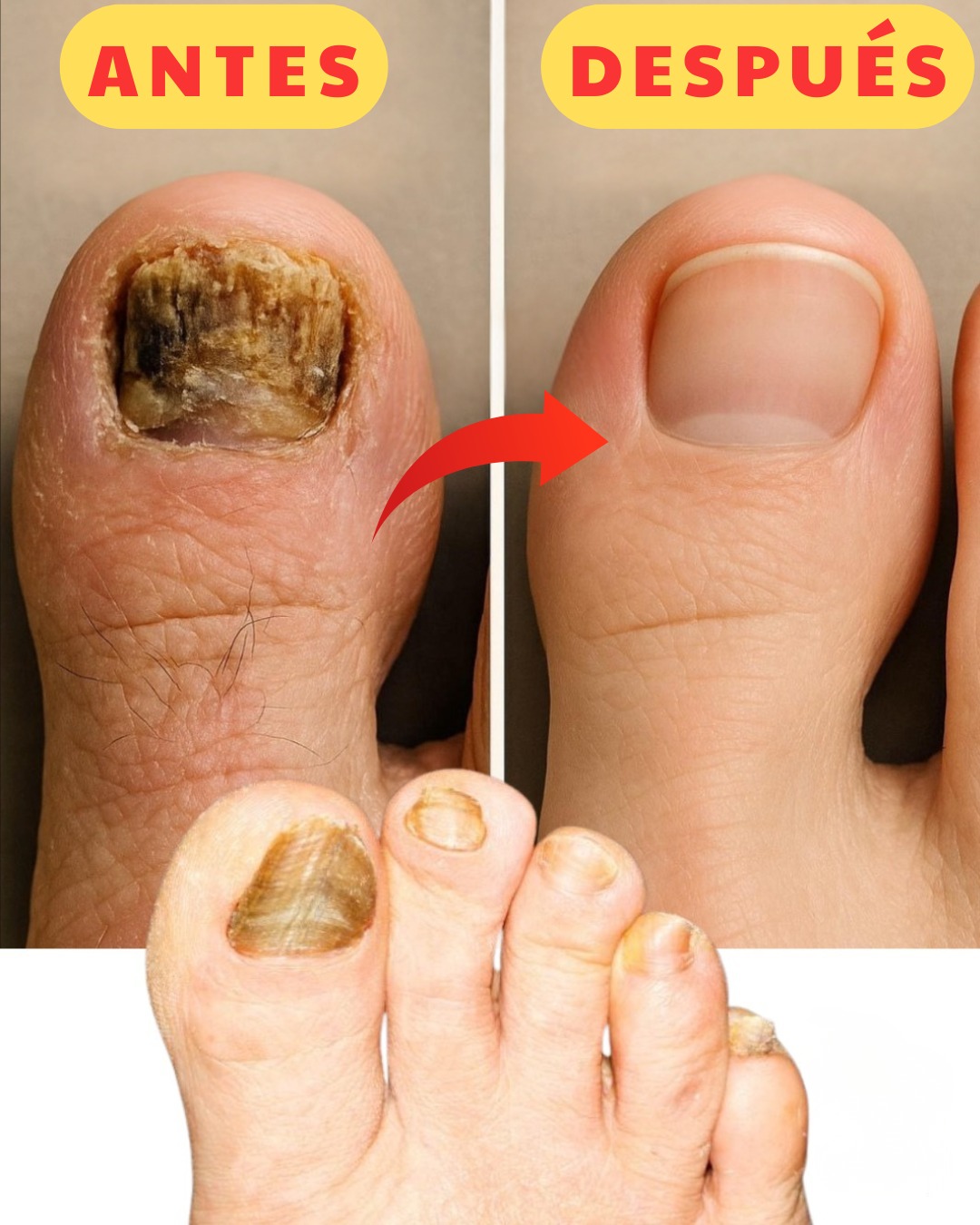 Así estaban mis uñas… hasta que probé este remedio casero. Receta en el primer comentario ⬇️ Escríbeme un hola para saber que me lees… ¡te regalo un tip de salud!